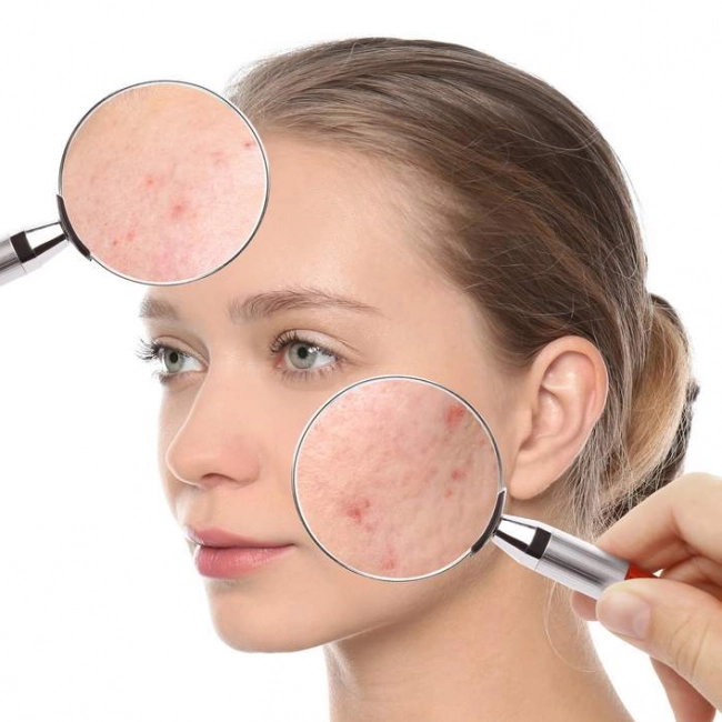 Boutons sur le visage : signification ? - laboratoire de biologie marine détox en France Image Boutons sur le visage : signification ?